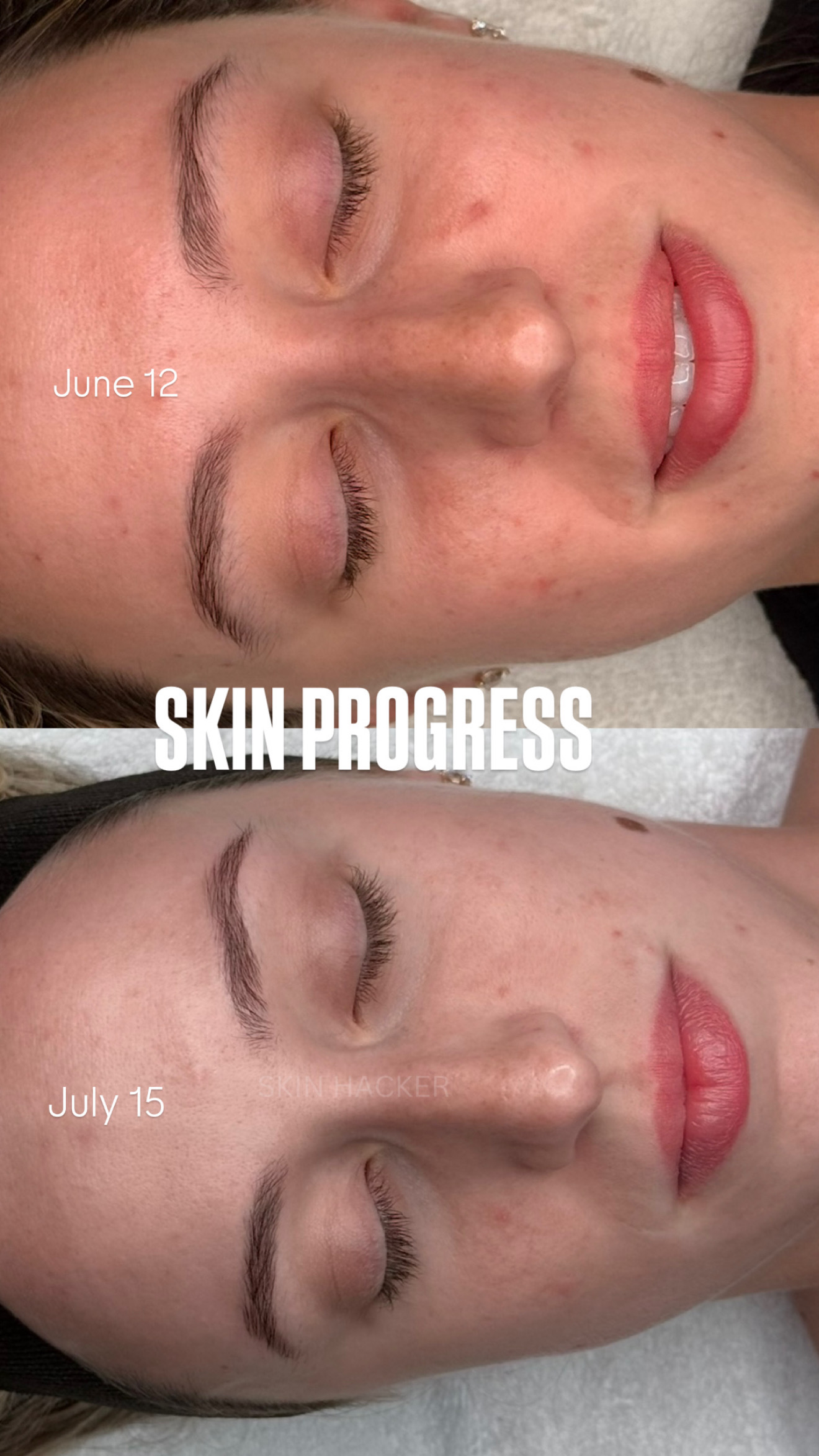 Comparison of a person's face showing skin improvement over time, with closed eyes and lips slightly parted.
