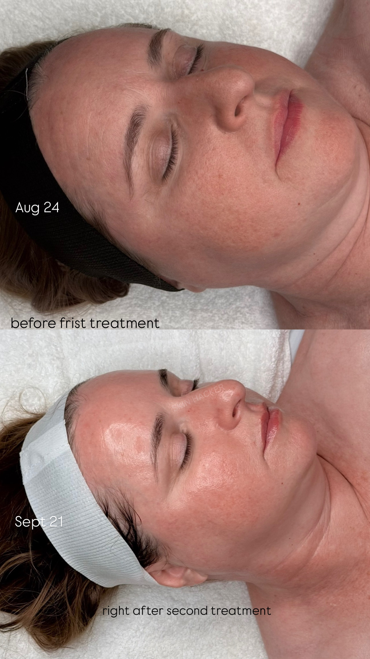 Side view of a woman's face before and after second treatment, showing skin improvement, with text labels and date.